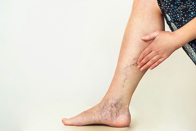 Lòng bàn chân xuất hiện nhiều mạch máu